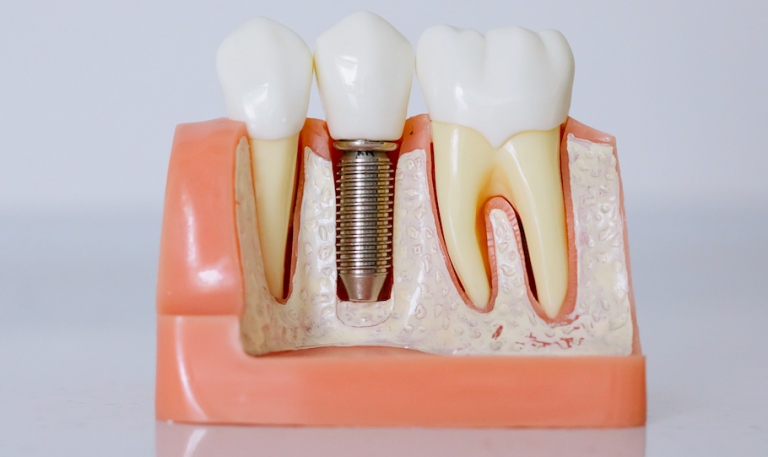 Come si Attacca il Dente all’Impianto Dentale: Processo e Procedura
