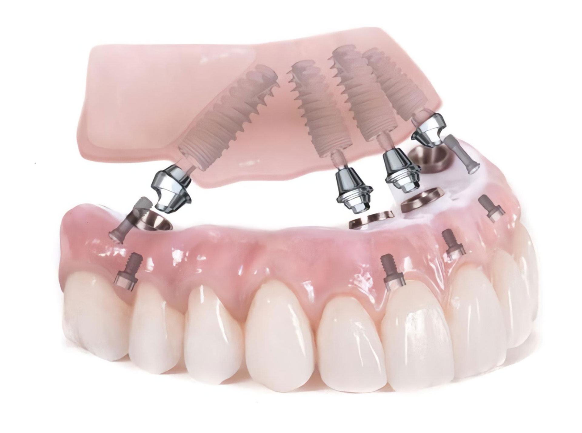 all on four inclinazione impianti dentista dental smile