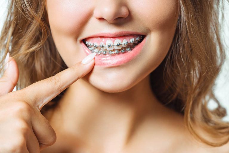 A quale età si mette l’apparecchio ai denti?