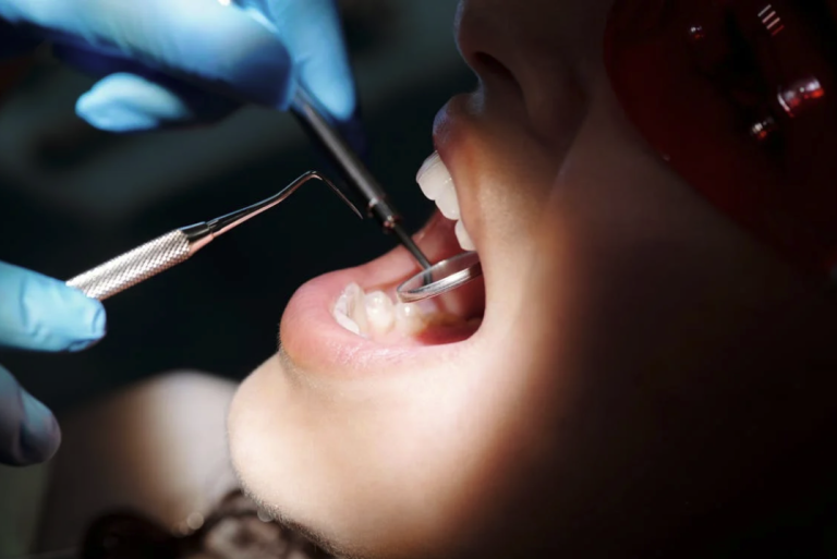 Affollamento dentale: cos’è e come si possono evitare i denti affollati