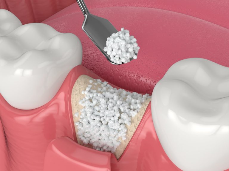 Impianto dentale con poco osso: esistono soluzioni?