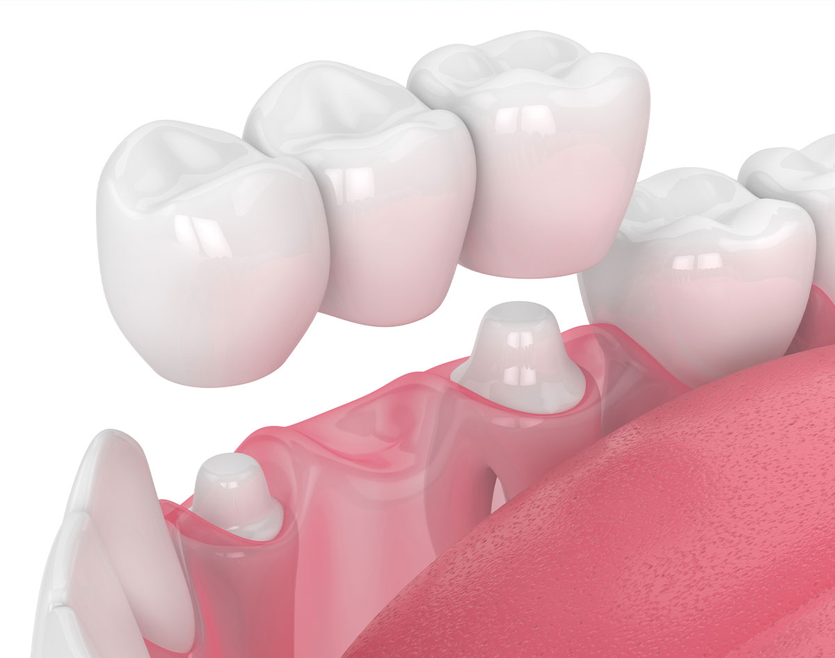 Corone dentali