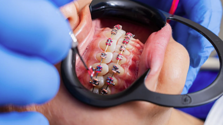 Bracket Apparecchio: Come funzionano gli apparecchi ortodontici e i brackets