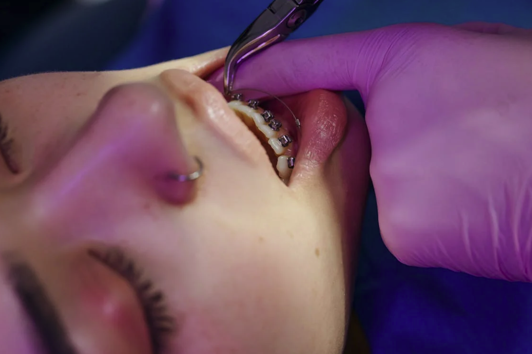Elastici apparecchio: Quanto tempo si portano gli elastici ortodontici?